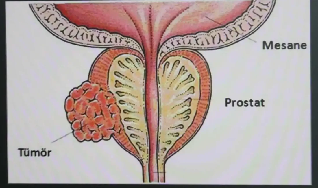Prostat kanseri nedir ve belirtileri nelerdir?