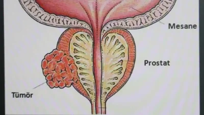 Prostat kanseri nedir ve belirtileri nelerdir?