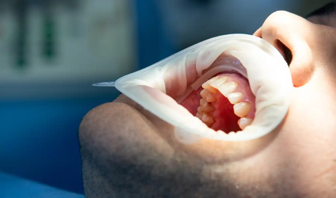 Uzmanından diş taşı ile ilgili önemli bilgiler